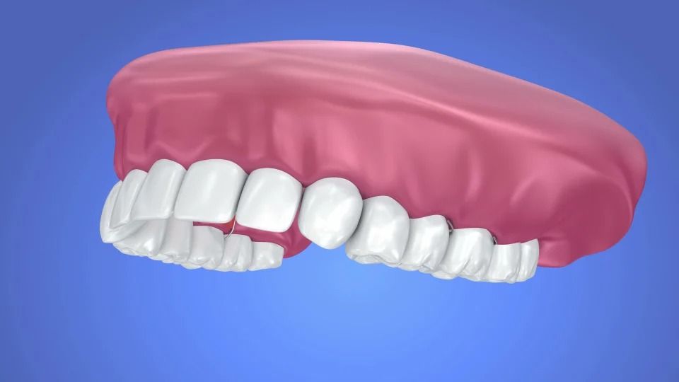 Effective Solutions to Replace Missing Tooth Pearl MS and Partial Dentures Brandon MS