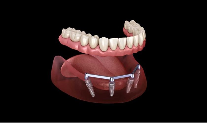 Understanding Implant Supported Dentures and Dental Implant Costs in Trussville, AL